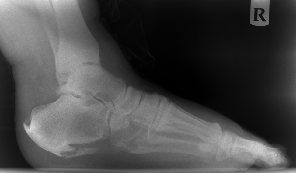 Ever have a heel spur?| Off-Topic Discussion forum |